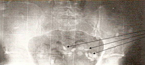 X-ray image of undigested pills