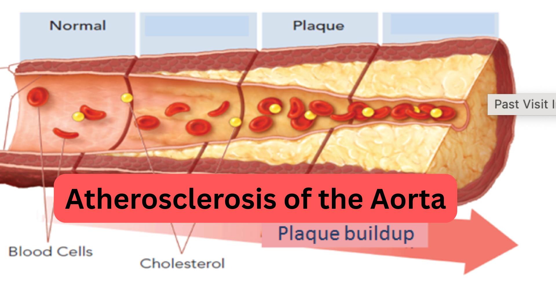 Atherosclerosis