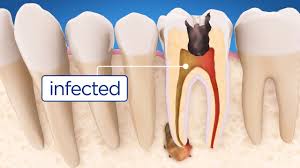 Infected Tooth