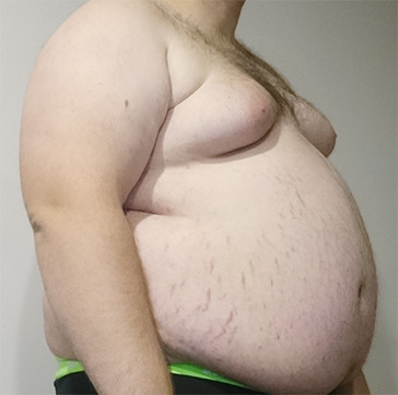 Obesity and Weight Gain